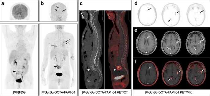 [ 18 F]FDG and [68 Ga]Ga-DOTA-FAPI-04 PET/CT in the evaluation of tuberculous lesions