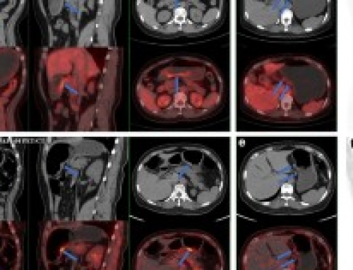 68 Ga-NOTA-FAPI-04 PET/CT in a patient with primary gastric diffuse large B cell lymphoma: comparisons with [ 18 F] FDG PET/CT