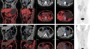 68 Ga-NOTA-FAPI-04 PET/CT in a patient with primary gastric diffuse large B cell lymphoma: comparisons with [ 18 F] FDG PET/CT
