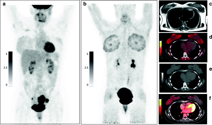 68Ga-FAPi-46 diffuse bilateral breast uptake in a patient with cervical cancer after hormonal stimulation