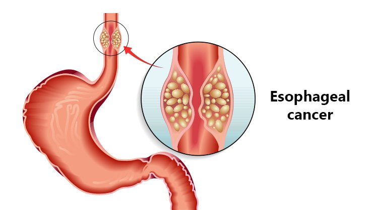 Esophageal-cancer
