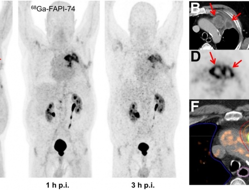 FAPI-74 PET/CT Using Either 18 F-AlF or Cold-Kit 68 Ga Labeling: Biodistribution, Radiation Dosimetry, and Tumor Delineation in Lung Cancer Patients