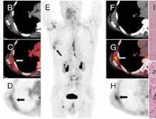 Incidental Detection of Elastofibroma Dorsi With 68Ga-FAPI-46 and 18F-FDG PET/CT in a Patient With Esophageal Cancer