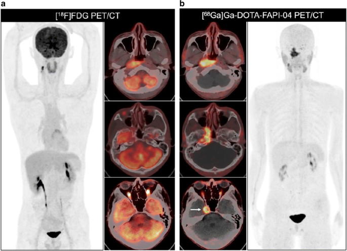 Usefulness of [ 68 Ga]Ga-DOTA-FAPI-04 PET/CT in patients presenting with inconclusive [ 18 F]FDG PET/CT findings