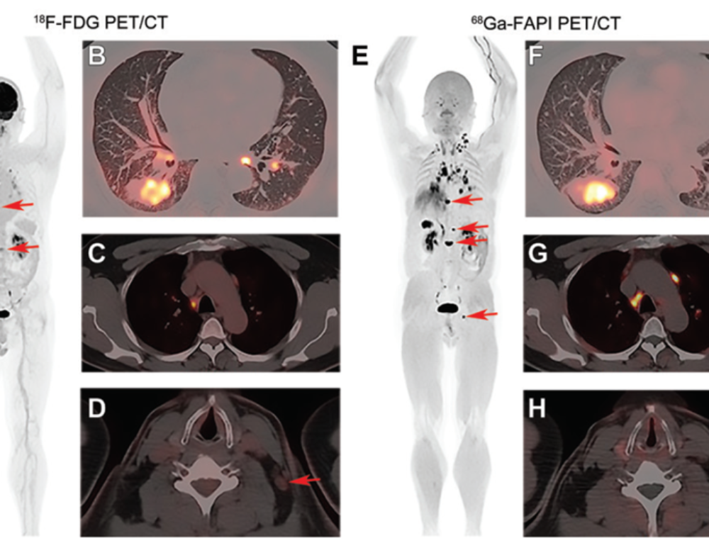 Feasibility of [ 68 Ga]Ga-FAPI-46 PET/CT for detection of nodal and ...
