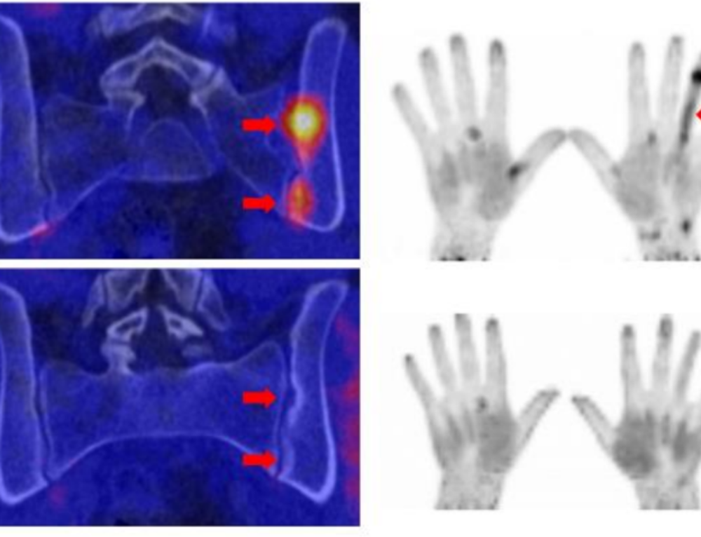 Safety and efficacy of 90Y-FAPI-46 radioligand therapy in patients with ...