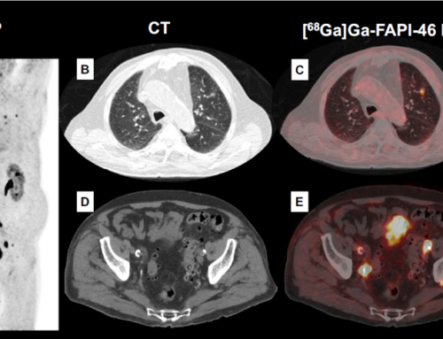 Feasibility of [ 68 Ga]Ga-FAPI-46 PET/CT for detection of nodal and hematogenous spread in high-grade urothelial carcinoma