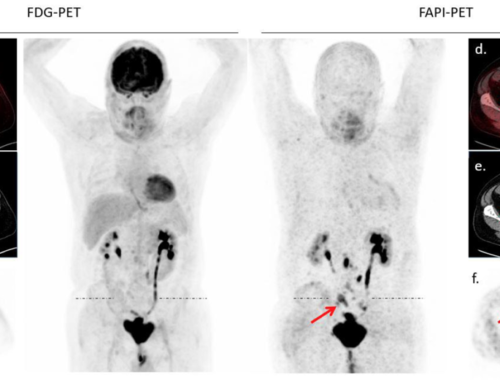 Head-to-head Intra-individual Comparison of [ 68 Ga]-FAPI and [ 18 F]-FDG PET/CT in Patients with Bladder Cancer