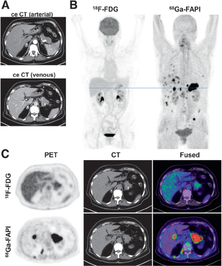 Impact of 68Ga-FAPI PET/CT Imaging on the Therapeutic Management of Primary and Recurrent Pancreatic Ductal Adenocarcinomas