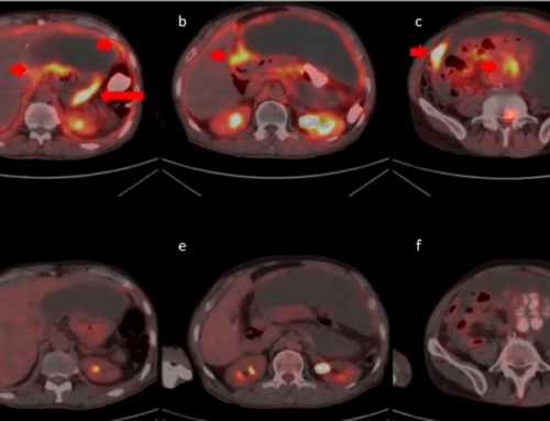 Comparison of 68 Ga-FAPI PET/CT and 18 FDG PET/CT Modalities in Gastrointestinal System Malignancies with Peritoneal Involvement