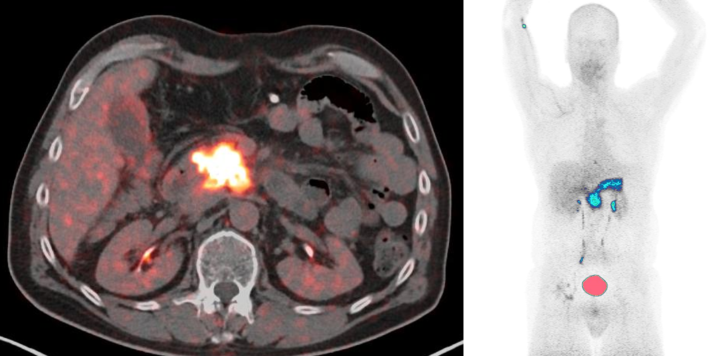 first FAPI patient scan