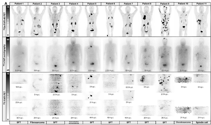 Safety and efficacy of 90Y-FAPI-46 radioligand therapy in patients with advanced sarcoma and other cancer entities