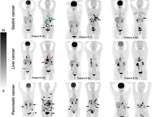 Fibroblast Activation Protein-Targeted PET/CT with 18F-Fibroblast Activation Protein Inhibitor-74 for Evaluation of Gastrointestinal Cancer: Comparison with 18F-FDG PET/CT