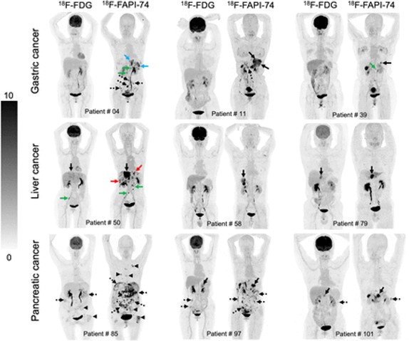 Fibroblast Activation Protein-Targeted PET/CT with 18F-Fibroblast Activation Protein Inhibitor-74 for Evaluation of Gastrointestinal Cancer: Comparison with 18F-FDG PET/CT