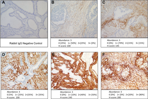 Gallium-68-labeled fibroblast activation protein inhibitor-46 PET in patients with resectable or borderline resectable pancreatic ductal adenocarcinoma: A phase 2, multicenter, single arm, open label non-randomized study protocol