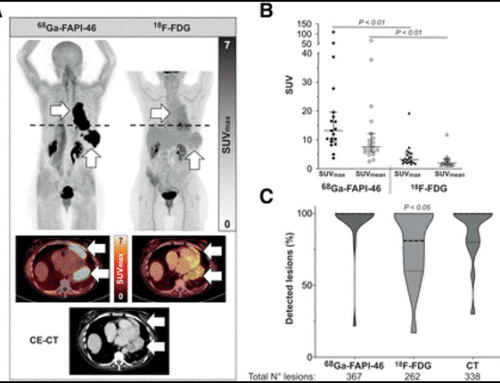 Fibroblast Activation Protein α-Directed Imaging and Therapy of Solitary Fibrous Tumor