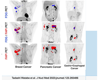 Current State of FAP Ligands for Diagnostic Use in Oncology