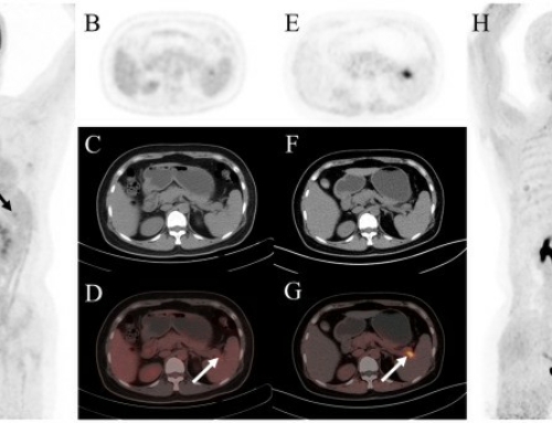 Head-to-head comparison of 18F-FDG and 68Ga-FAPI PET/CT in common gynecological malignancies