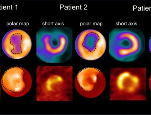 Spatial FAP Expression as Detected by 68 Ga-FAPI-46 Identifies Myofibroblasts Beyond the Infarct Scar After Reperfusion