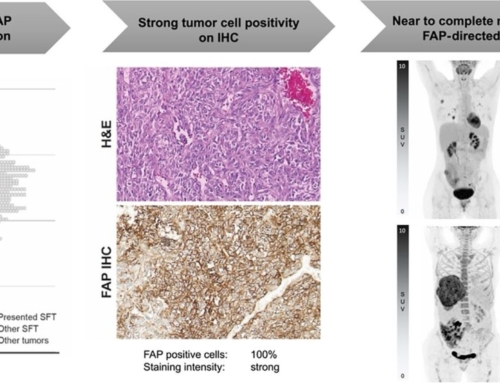 90 Y-FAPI-46 Theranostics Leads to Near-Complete Metabolic Response in 3 Patients with Solitary Fibrous Tumors