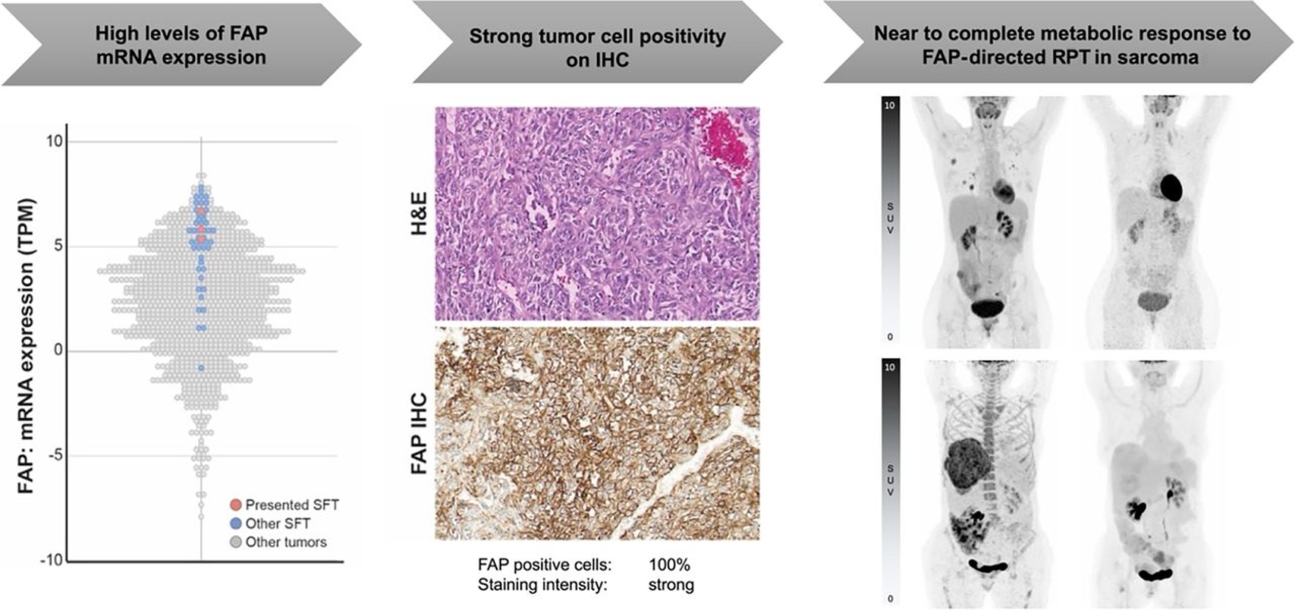 90Y-FAPI-46 Theranostics Leads to Near-Complete Metabolic Response in 3 Patients with Solitary Fibrous Tumors