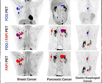 Addressing Unmet Needs with [18F]FAPI-74