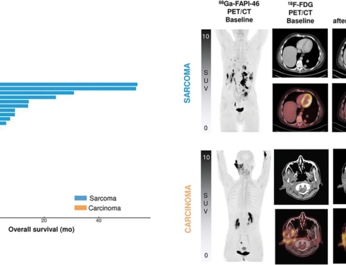 90Y-FAPI-46 Radiopharmaceutical Therapy in Sarcoma and Other Solid Tumors: An Updated Cohort Analysis  