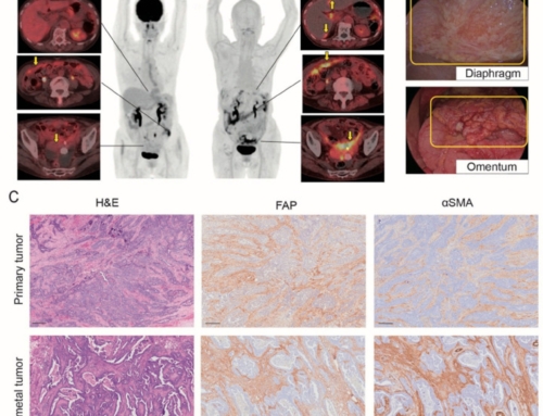 [18F]FAPI-74 PET for Preoperative Assessment of Peritoneal Dissemination in Ovarian Cancer: A Case Series with Surgical and Histopathological Correlation