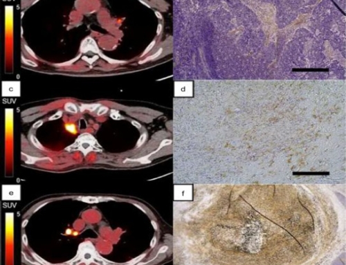 Fibroblast activation protein inhibitor-PET/CT in lung cancer: a prospective single-center study with histopathological correlation of fibroblast activation protein expression